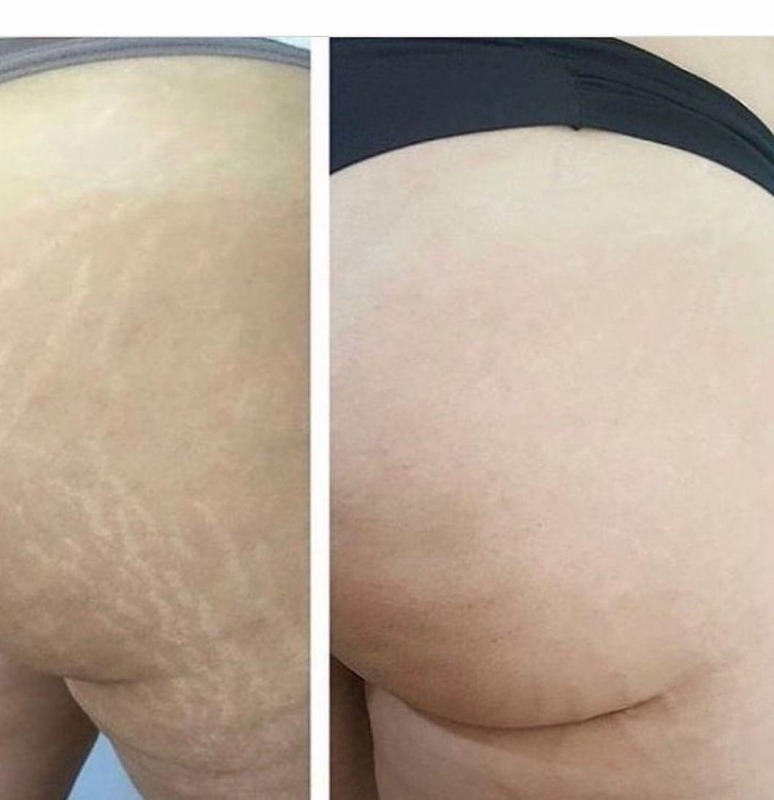 Antes e depois camuflagem de estrias no glúteo