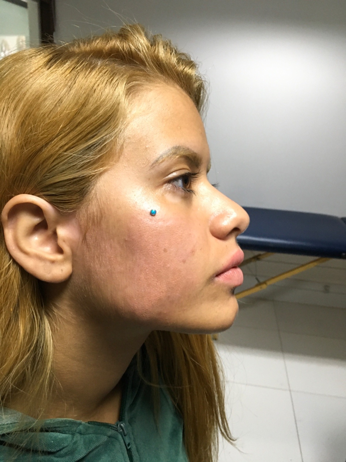 Depois da camuflagem de vitiligo no rosto