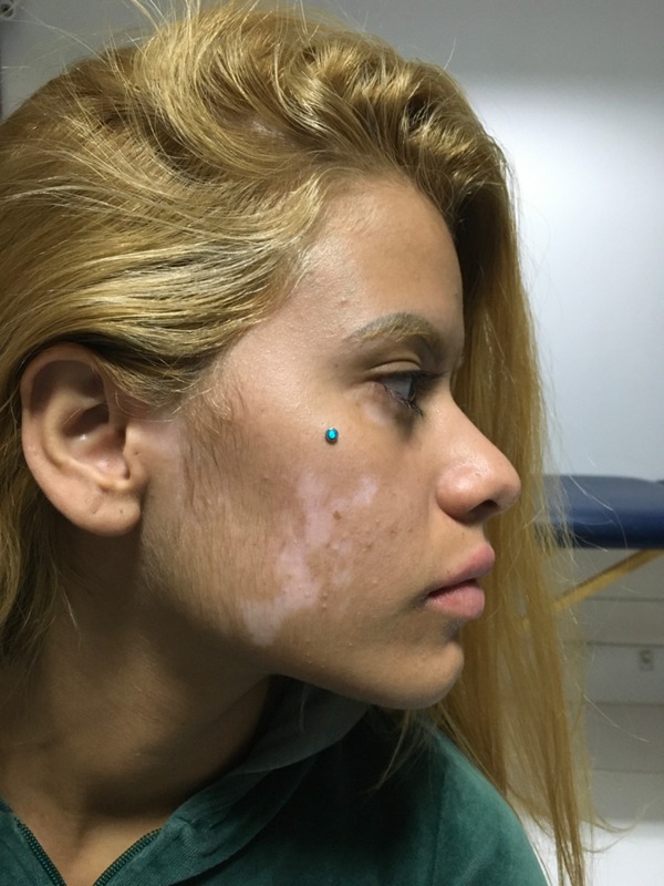 Antes da camuflagem de vitiligo no rosto