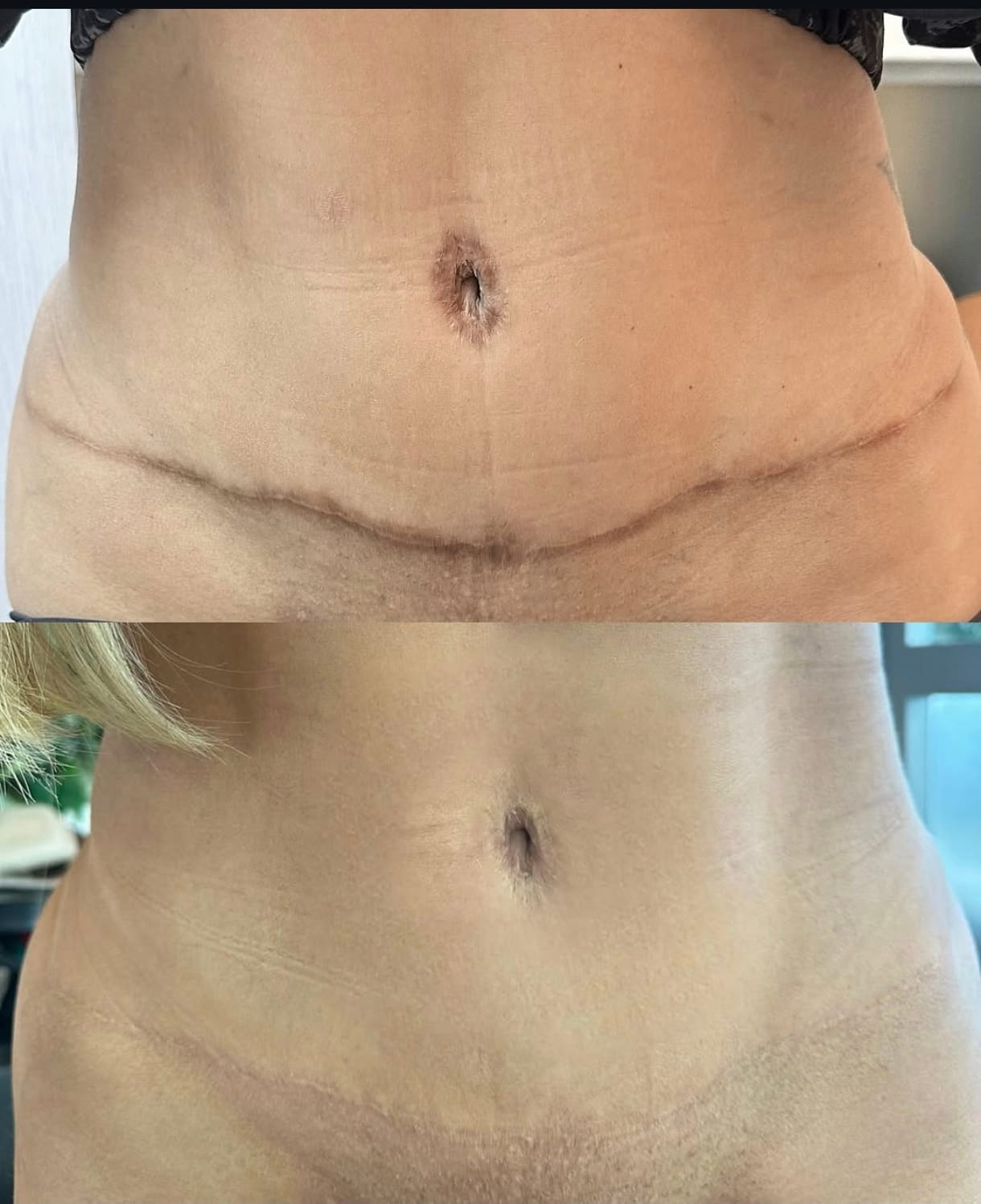 Antes e depois de camuflagem de cicatriz de abdominoplastia