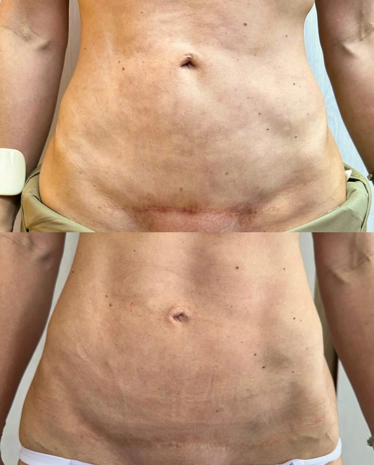 Antes e depois de camuflagem de cicatriz abdominal