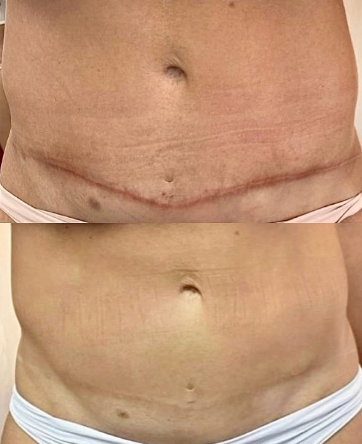 Antes e depois de camuflagem de cicatriz de abdominoplastia
